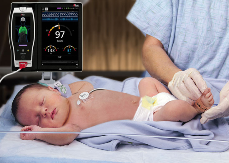 Masimo - Colocación del sensor RAS en el pie derecho de pacientes recién nacidos